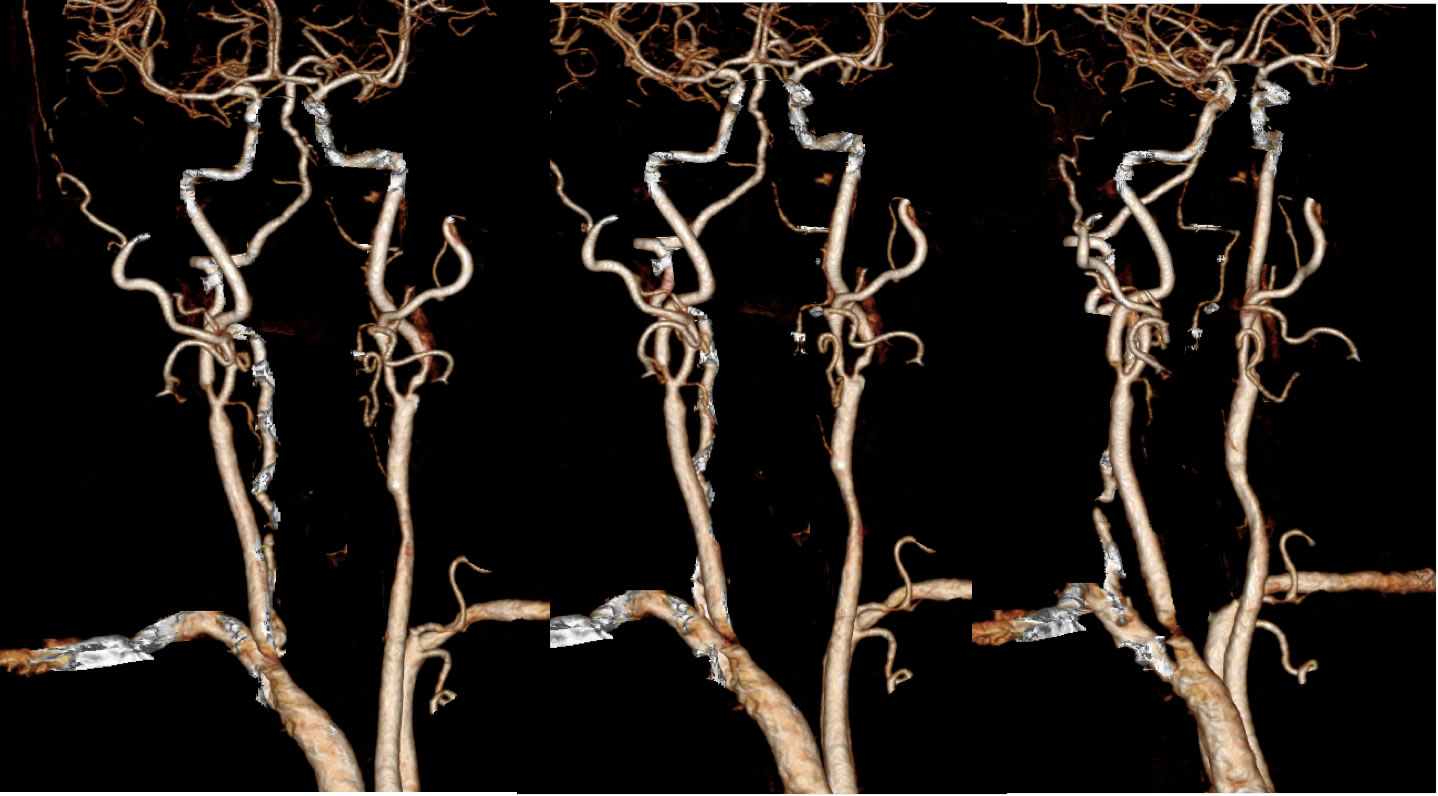 Bilateral Carotid And Right Vertebral Stenosis LVA Occlusion